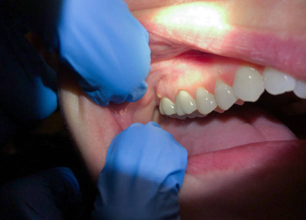 Best Emergency Gum Treatment in Jarrell, TX